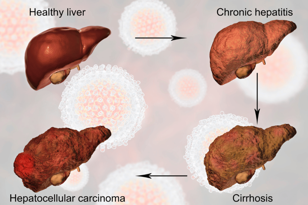 liver comparison